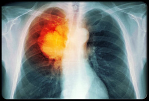lung-cancer-s5-lung-cancer-xray